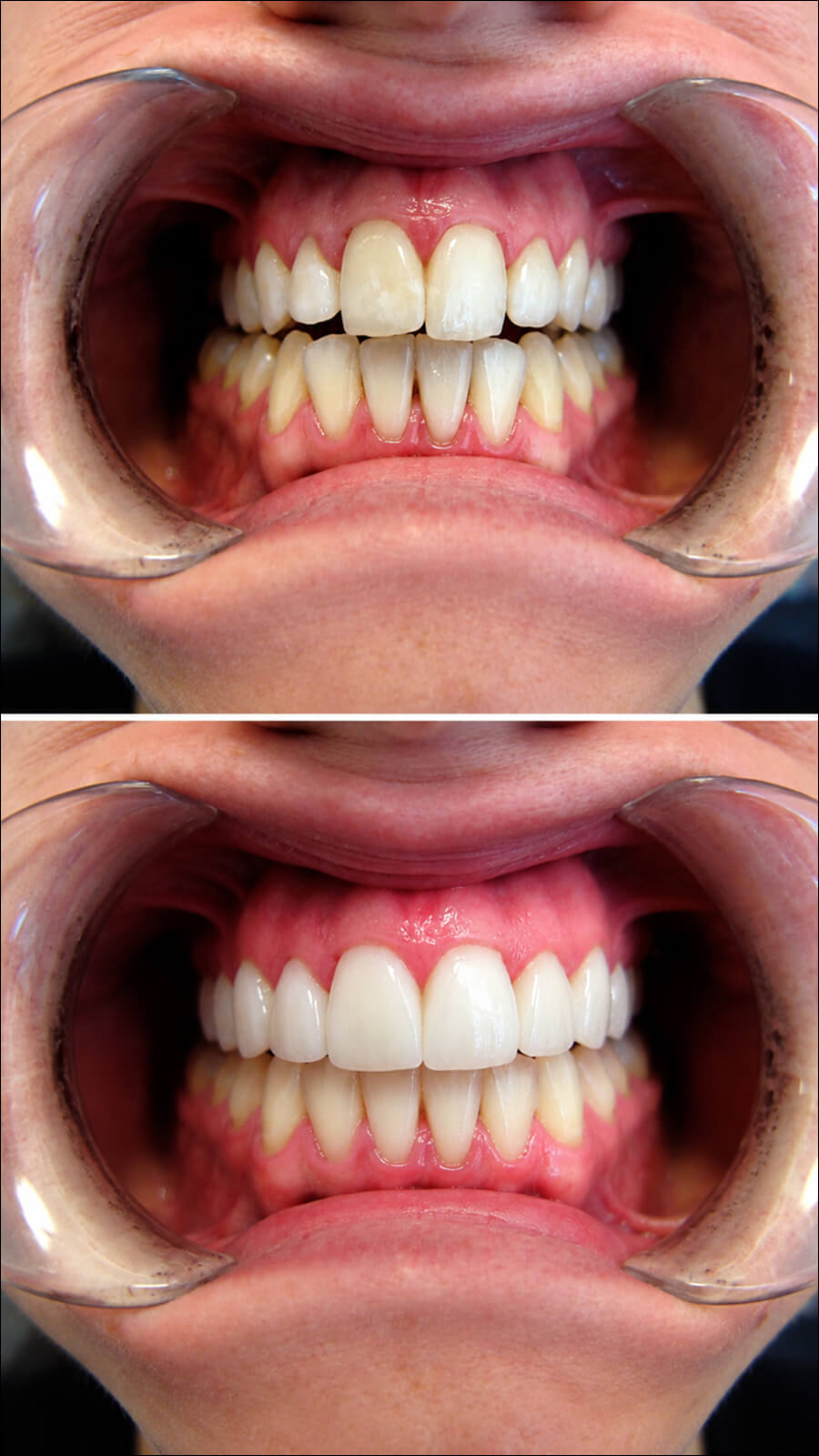 Before and after of an upper smile made brighter and more even at Plainsboro Family Dentistry in Plainsboro, NJ
