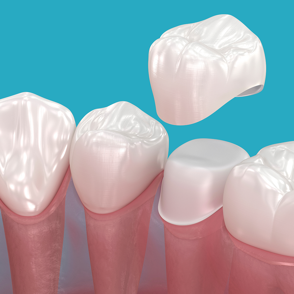 Crowns & Bridges at Plainsboro Family Dentistry in Plainsboro, NJ