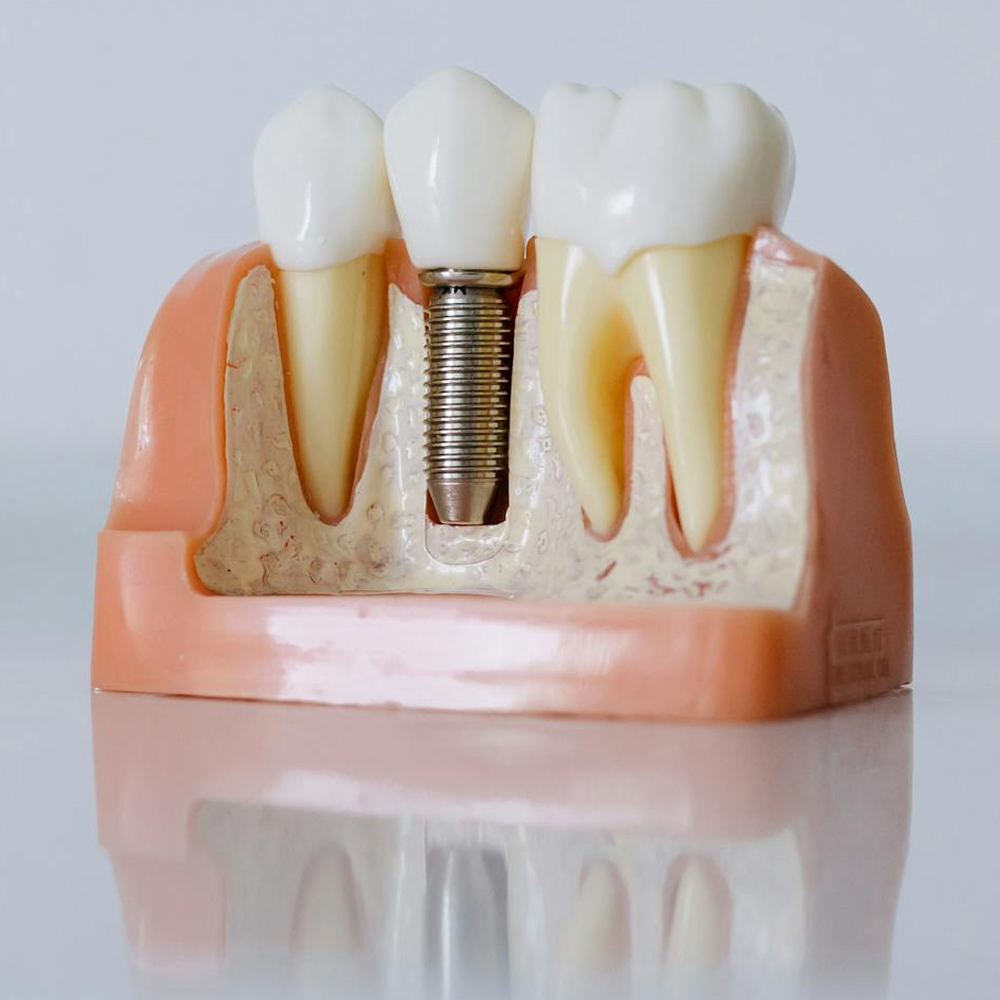 Dental Implants at Plainsboro Family Dentistry in Plainsboro, NJ
